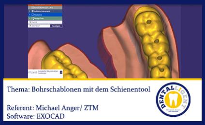 2016-EXOCAD  -Bohrschablonen mit dem Schienentool 