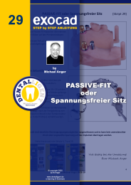 Exocad Step by Step Anleitung - Nr. 29 PASSIVE-FIT oder Spannungsfreier Sitz 