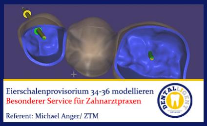 2017-NEW EXOCAD TUTORIAL  - Eierschalenprovisorium 34-36 modellieren 