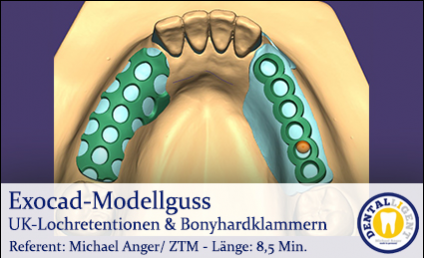 2019-Exocad-Modellguss UK-Lochretentionen & Bonyhardklammern 