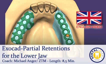 2019-Exocad-Partial Retentions for the Lower Jaw  -ENGLISH 