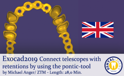 2019-Exocad -  Connect telescopes with retentions by using the pontic-tool 