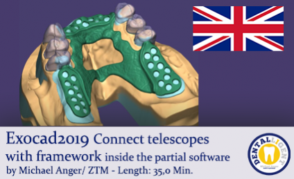 2019-Exocad -  Connect telescopes with framework inside the partial software 