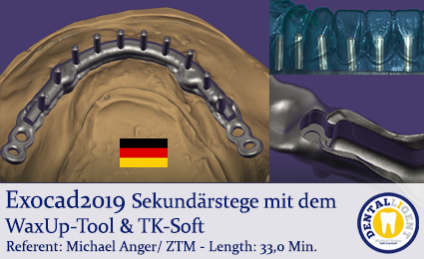 2019-Exocad - Sekundärstege mit dem WaxUp-Tool & TK-Soft 