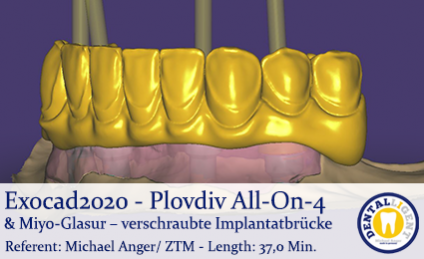 2020-Exocad - Exocad Plovdiv - All-On-4 & Miyo-Glasur – verschraubte Implantatbrücke 