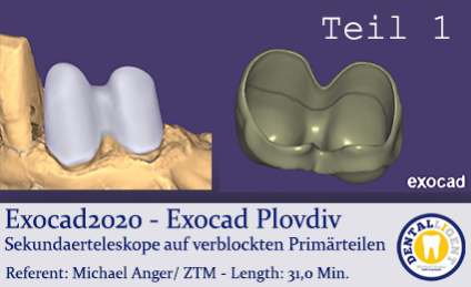 2020-Exocad - Exocad Plovdiv - Sekundaerteleskope auf verblockten Primärteilen - Teil1 