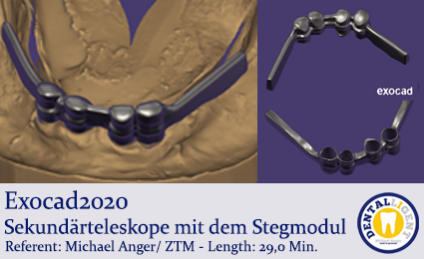 2020-Exocad - Sekundärteleskope mit dem Stegmodul 