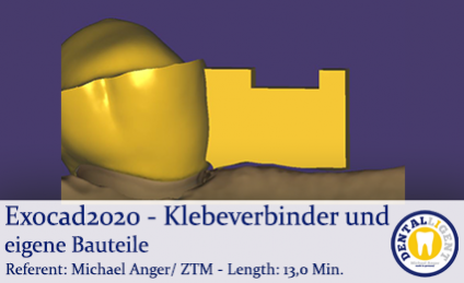 2020-Exocad - Exocad-Plovdiv – Klebeverbinder und eigene Bauteile 