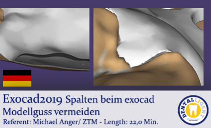 2019-Exocad - Spalten beim exocad Modellguss vermeiden   