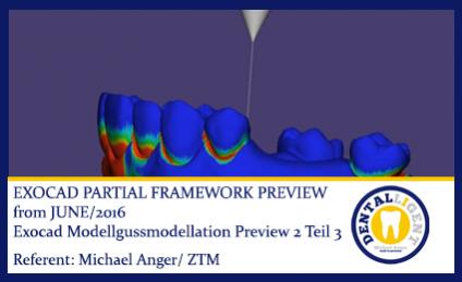 2016-EXOCAD  -Exocad Modellgussmodellation Preview 2 Teil 3 