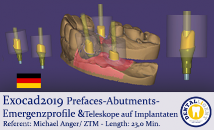 2019-Exocad-Prefaces-Abutments-Emergenzprofile &Teleskope auf Implantaten 