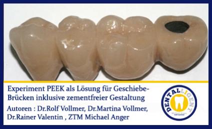 GRATIS - Experiment - PEEK als Lösung für Geschiebe-Brücken inkl. zementfreier Gestaltung 