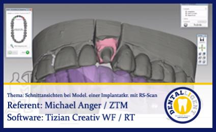 Schnittansichten bei Modellation einer Implantatkrone mit Renishaw-Scan 