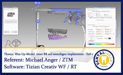 Wax-Up-Modellation einer Brücke auf einteiligen Implantaten - Teil 1 