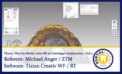 Wax-Up-Modellation einer Brücke auf einteiligen Implantaten - Teil 2 