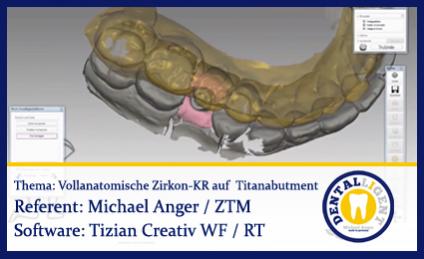Modellation einer vollanatomischen Zirkonkrone auf einem Titanabutment 