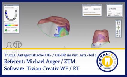 Modellation von antagonistischen OK- und UK-Brücken im virtuellen Artikulator - Teil 1 
