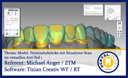 Modellation einer Frontzahnbrücke mit Situations-Scan im virtuellen Arti - Teil 1 