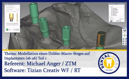 Modellation eines Dolder-Macro-Steges auf Implantaten (16-26)  - Teil 1 