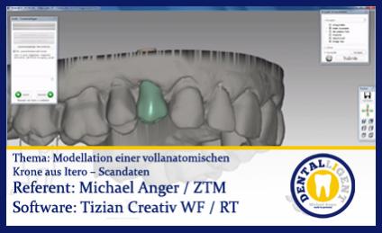 Modellation einer vollanatomischen  Krone aus Itero – Scandaten 