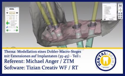 Modellation eines Dolder-Macro-Steges  mit Extensionen auf Implantaten (35-45) Teil 1 