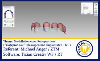 Modellation einer Reiseprothese (Ersatzprothese) auf Teleskopen und Implantaten - Teil 1 
