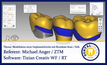 Modellation einer Implantatbrücke mit Renishaw-Scan / Fall1 