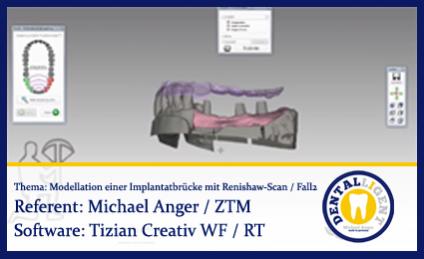 Modellation einer Implantatbrücke mit Renishaw-Scan / Fall2 - Teil 2 