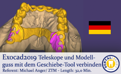 2019-Exocad - Teleskope und Modellguss mit dem Geschiebe-Tool verbinden 