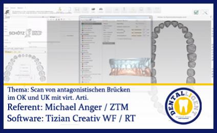 Scan von antagonistischen Brücken im OK und UK mit virt. Arti. 