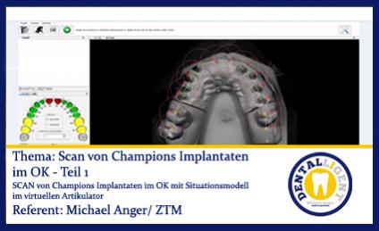 GRATIS - Scan von Champions Implantaten im OK - Teil 1 