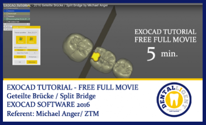 2016-FREE FULL EXOCAD SUPPORT-Video - About: Geteilte Brücke 