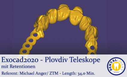 2020-Exocad - Exocad-Plovdiv - Teleskope mit Retentionen 