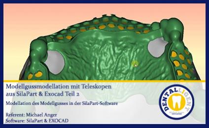 Modellgussmodellation mit Teleskopen aus SilaPart & Exocad Teil 2 