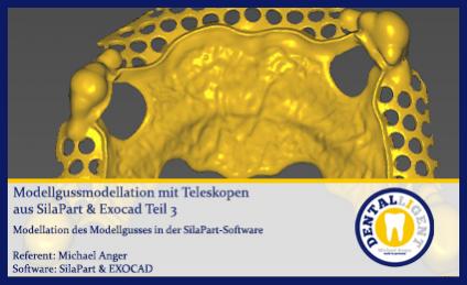 Modellgussmodellation mit Teleskopen aus SilaPart & Exocad Teil 3 