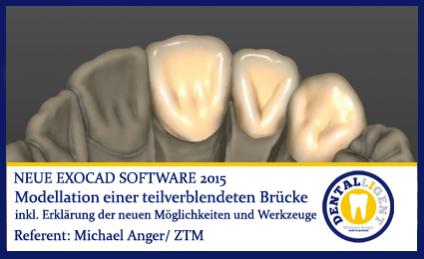 2015-Modellation einer teilverblendeten Brücke - Exocad 2015 