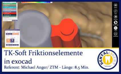 Exocad-2019TK-Soft Friktionselemente in exocad 