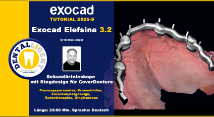 Exocad Elefsina 3.2 - 2025-9 - Sekundärteleskope mit Stegdesign für CoverDenture 