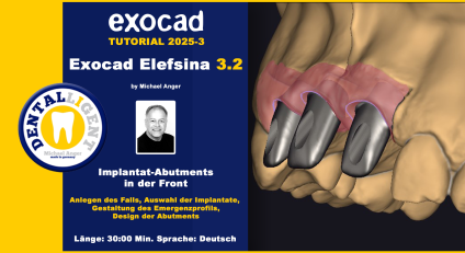 Exocad Elefsina 3.2 - 2025-2 - Teleskope + skelettierter Modellguss im Stegdesign TEIL 2 