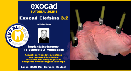 Exocad Elefsina 3.2 - 2025-8 - Implantatgetragene Teleskope auf Mundscans 