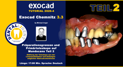 Exocad Chemnitz 3.3 - 2026-04 - Präparationsgrenzen und Primärteleskope auf Mundscans - Teil 2 