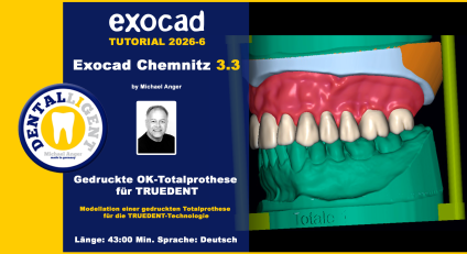 Exocad Chemnitz 3.3 - 2026-06 - Gedruckte OK-Totalprothese für TRUEDENT 