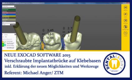 2015-Verschraubte Implantatbrücke auf Klebebasen - Exocad 2015 