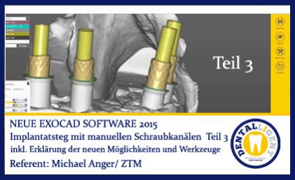 2016-Implantatsteg mit manueller Schraubkanalpositionierung Teil 3 - Exocad 2016 
