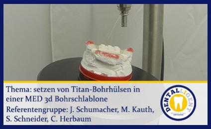 Setzen von Titan-Bohrhülsen in einer MED-3D Bohrschablone 